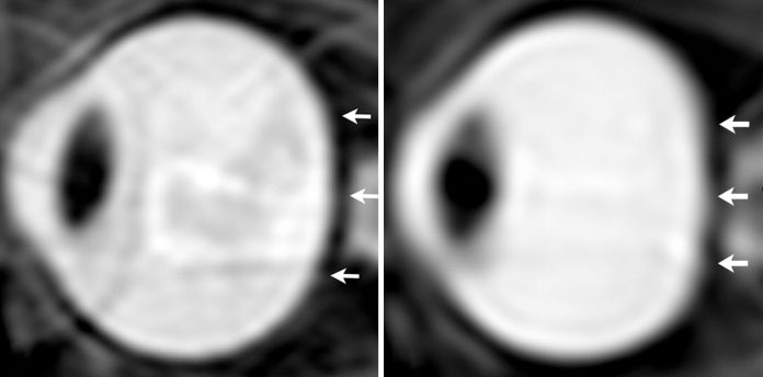 Two images of an eyeball, side by side. The left was taken on Earth, and the right was taken while in space. The right eyeball is squished and much more flat on the right side. (Credit: NASA)